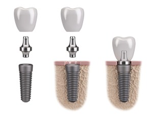 Photo of Dental Implants procedure